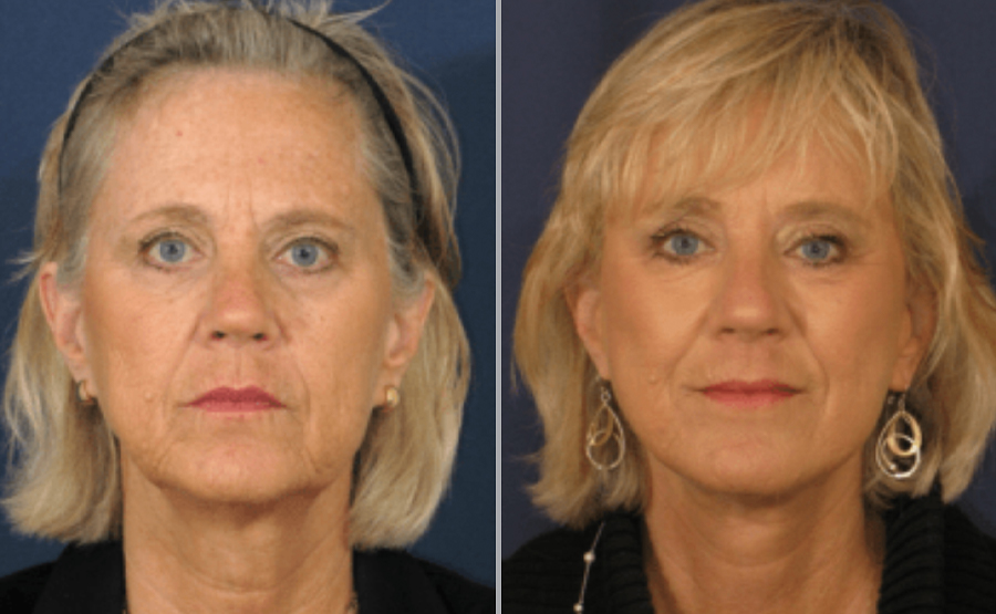 Facelift Before and After Pictures San Diego, CA