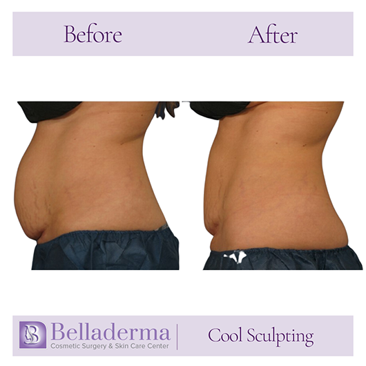 CoolSculpting® for Men  Advanced Skin & Body Solutions