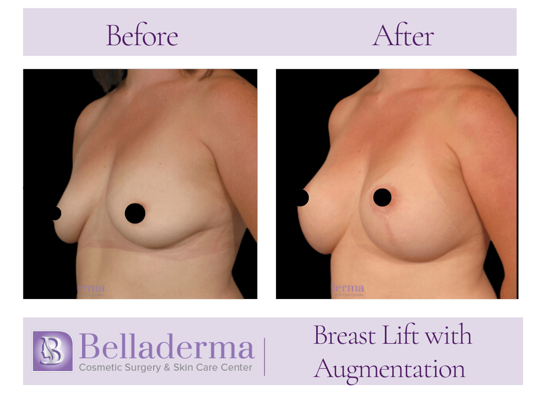 Breast Augmentation with Lift Before and After Photos